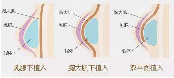 曼托隆胸術(shù)前需準(zhǔn)備什么？