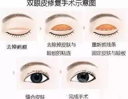 白永輝醫(yī)生擅長項目科普:眼修復(修復雙眼皮)