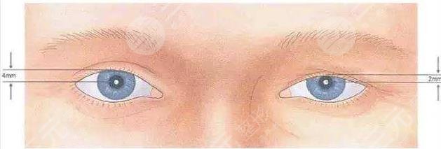 上瞼下垂矯正