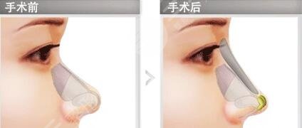 濟南藝星做鼻部手術(shù)案例