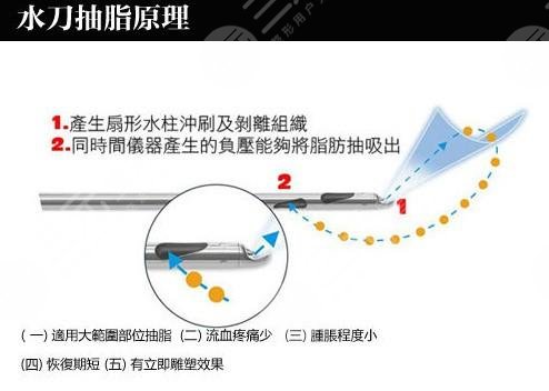 水動力吸脂原理