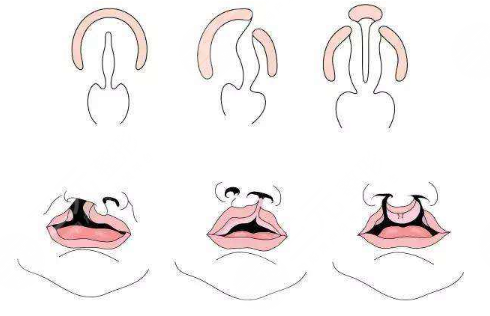 唇腭裂鼻子修復(fù)多大年齡合適？
