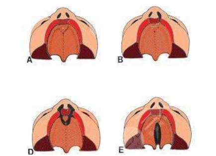 唇腭裂修復(fù)過程和時(shí)間需要多久？