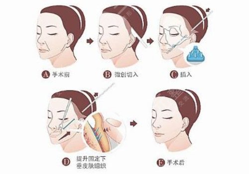 拉皮手術(shù)前注意事項(xiàng)