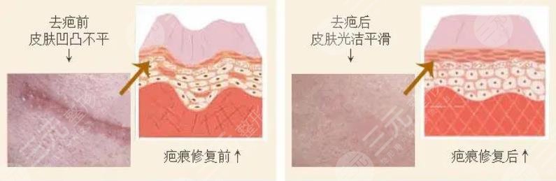 深圳激光去疤痕有嗎?