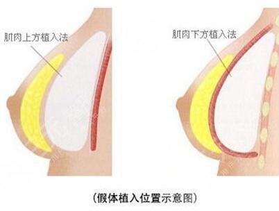 魔滴和曼托怎么選擇？