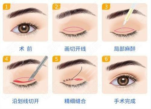 深圳因美整形醫(yī)院雙眼皮案例