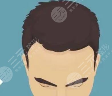 唐山煤醫(yī)尚美整形美容醫(yī)院植發(fā)際線案例分享