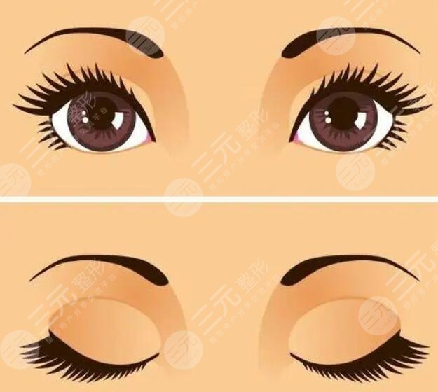 鄭州二院割雙眼皮手術(shù)