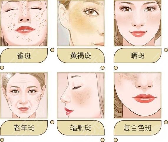 淮安市第一人民醫(yī)院激光祛斑網(wǎng)友親身體驗日記|案例:術前