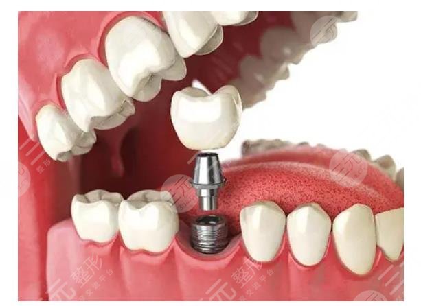 　牙齒種植體十大排名NO.9、?？怂狗N植體
