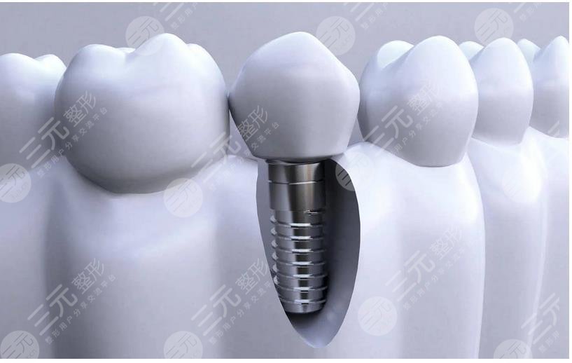 齒種植體十大排名NO.7、捷邁種植體