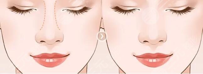 薛克墘隆鼻果圖