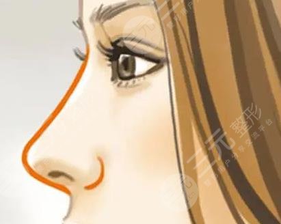 肋骨隆鼻1-7天恢復(fù)過(guò)程圖分享！真人隆鼻體驗(yàn)經(jīng)歷分享+附收費(fèi)價(jià)格表