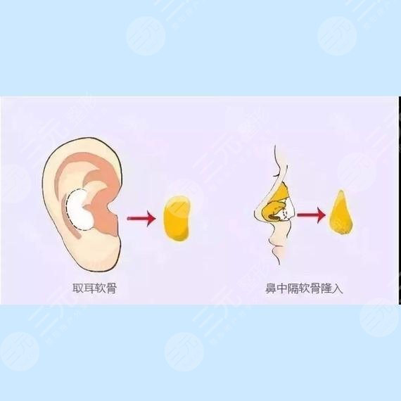 耳軟骨和肋骨鼻子的區(qū)別在哪里?