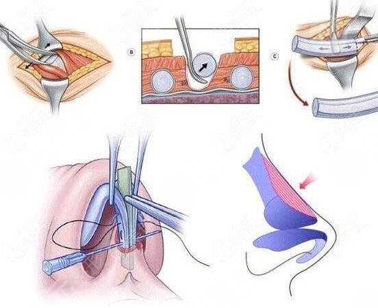 自體軟骨鼻子整形都有哪些優(yōu)點(diǎn)?