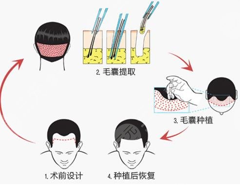 植發(fā)都有哪些優(yōu)勢?