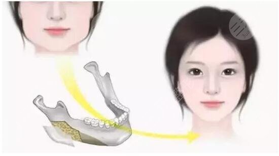 #術(shù)前功課#磨骨瘦臉手術(shù)多少錢？