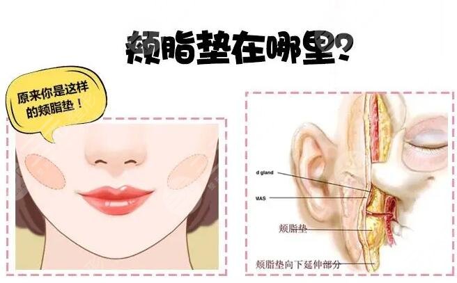 頰脂墊位置圖分解圖，取了就瞬間變瓜子臉？真有這么神奇？