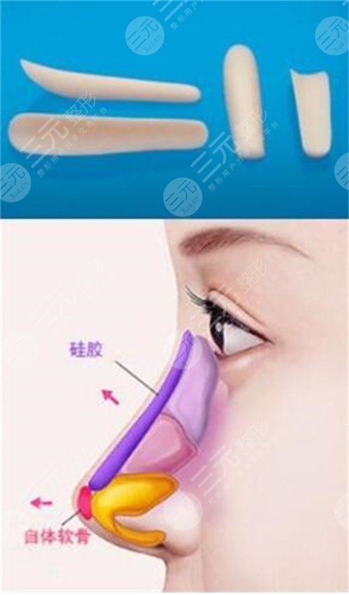 如何能讓自己的鼻子變高變挺 鼻子整形手術(shù)會有什么后遺癥 鼻子整形手術(shù)的后遺癥有哪些是什么