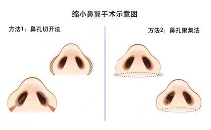 骨膜下隆鼻整形手術(shù)怎么做的？哪種情況適合做？