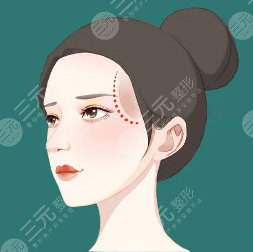 脂肪填眼窩一年后圖片