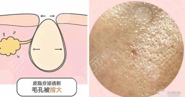 什么辦法可以讓毛孔縮小