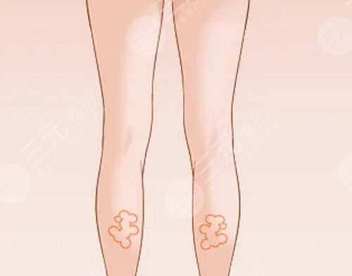 ****注射瘦腿降低風險嗎