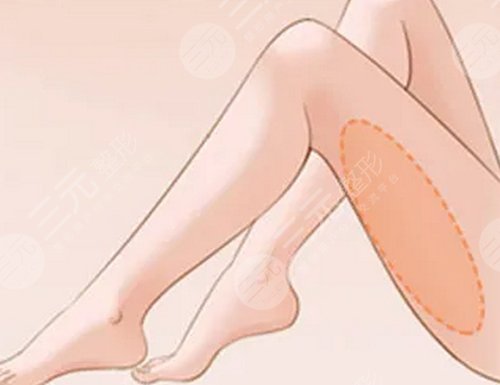 ****注射瘦腿降低風險嗎