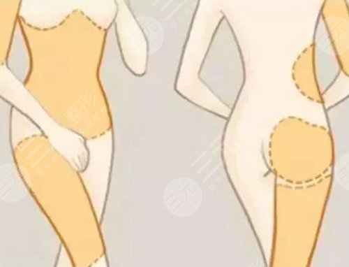 打注射瘦腿多少錢？多少錢一針比較合適？