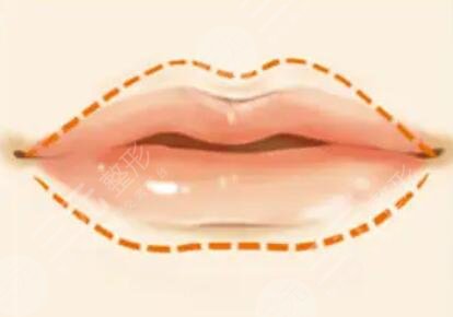 紋唇一到七天恢復(fù)圖片真實(shí)過(guò)程：好唇色襯托好氣色！早上出門(mén)節(jié)約幾分鐘！