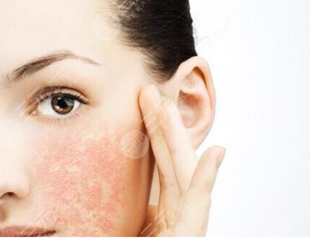 光子嫩膚一到七天圖|案例反饋:不僅毛孔收縮，斑點也有所改良~