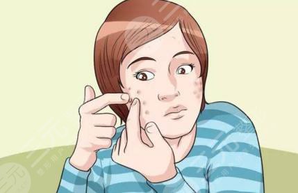 激光祛痘后需要注意什么?