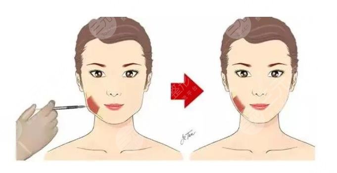 注射瘦臉術(shù)前要做好什么準(zhǔn)備