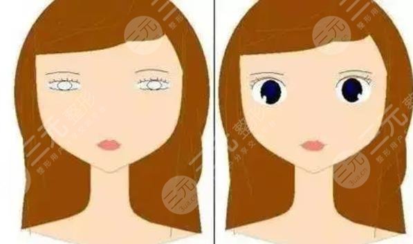 女子割雙眼皮視力下降