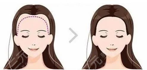 發(fā)際線種植