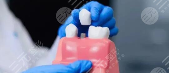 進(jìn)口種植體品牌大全及價(jià)格明細(xì)