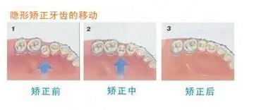 牙齒矯正過(guò)程
