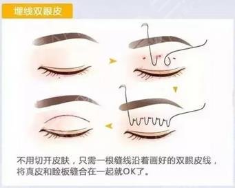 雙眼皮手術(shù)過(guò)程