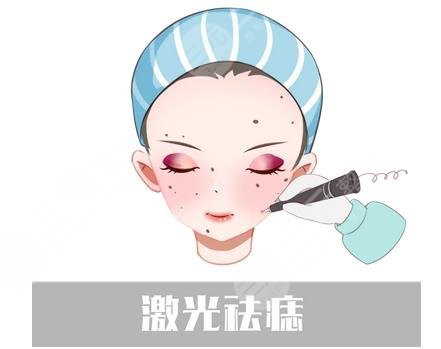 激光去痣