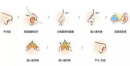 隆鼻過(guò)程