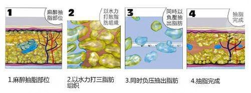 怎么使鼻子變小?