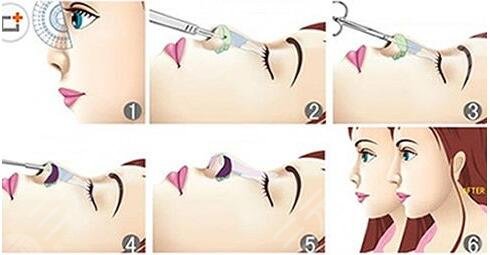 韓式生科假體隆鼻價格