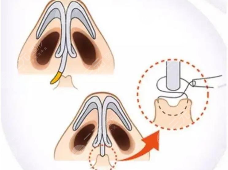 長(zhǎng)沙秦曉東醫(yī)生鼻子案例|網(wǎng)友鼻小柱延長(zhǎng)親身體會(huì)