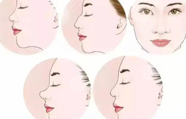 肋骨隆鼻三個(gè)月變化圖、手術(shù)前