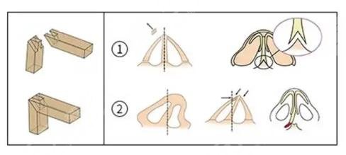 膨體隆鼻有哪些優(yōu)點(diǎn)