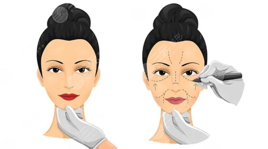 小拉皮手術(shù)可以維持多久