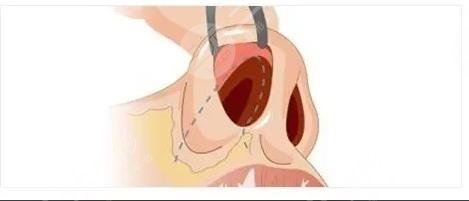 鼻子修復(fù)必須要滿3個月嗎？二次鼻整形術(shù)前指南！小白必看~