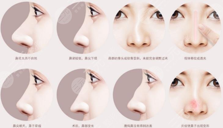 鼻子修復(fù)必須要滿3個月嗎？二次鼻整形術(shù)前指南！小白必看~