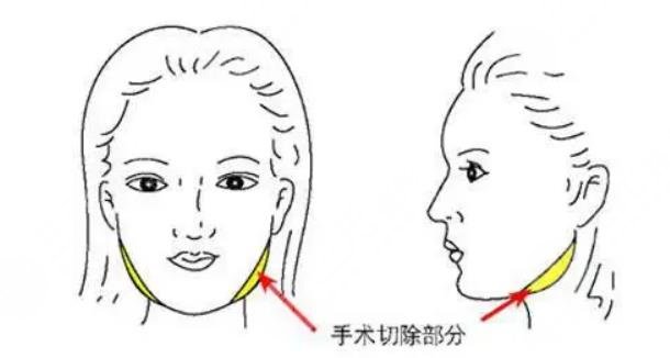 華西和友誼磨骨哪個(gè)貴